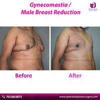 Best Gynecomastia Surgery in Hyderabad