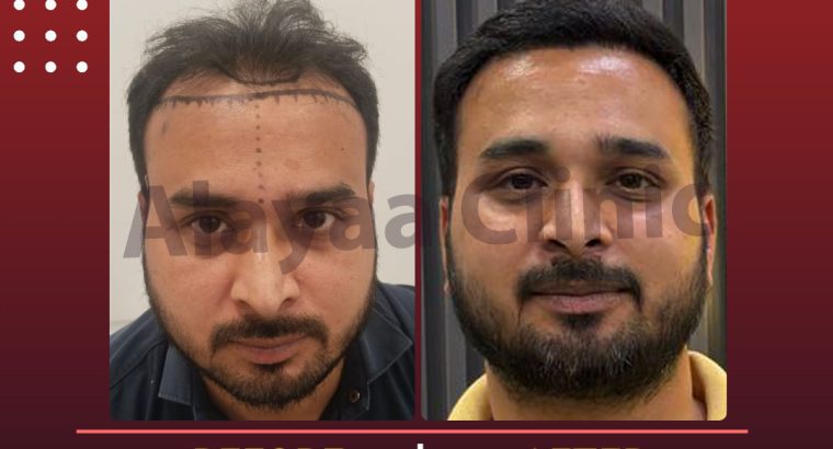 Premier Hair Transplant Specialist in Chandigarh Top Hair Restora